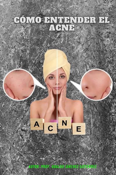 Produktbild: Entendiendo el acn&eacute;