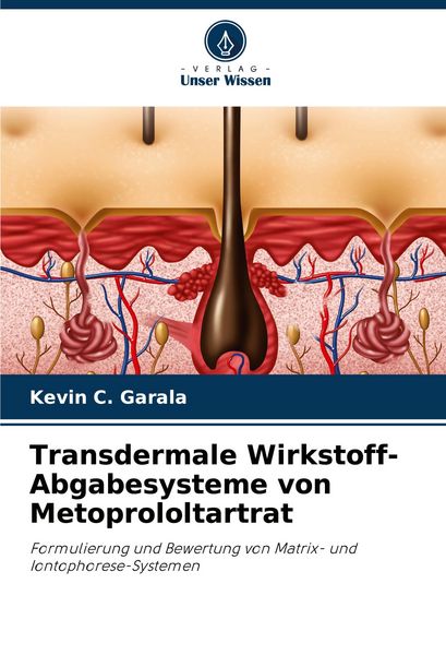 Transdermale Wirkstoff-Abgabesysteme von Metoprololtartrat, Taschenbuch von Kevin C. Garala, Verlag Unser Wissen, 9786208309190