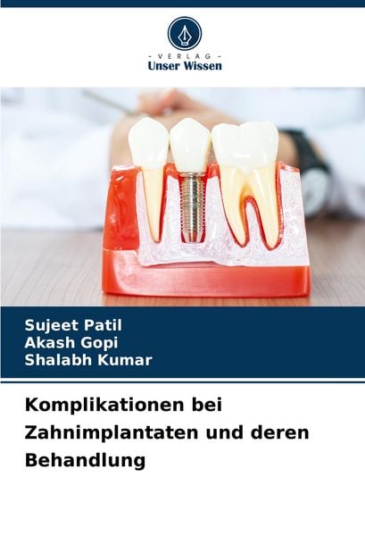 Produktbild: Komplikationen bei Zahnimplantaten und deren Behandlung