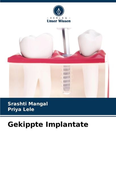 Produktbild: Gekippte Implantate