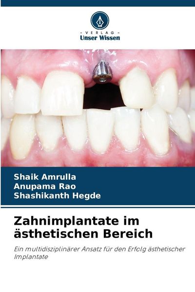 Produktbild: Zahnimplantate im &auml;sthetischen Bereich
