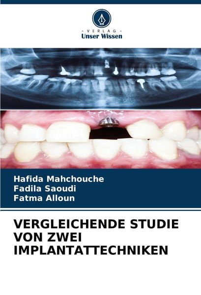 Vergleichende Studie von zwei Implantattechniken, Taschenbuch von Hafida Mahchouche , Fadila Saoudi , Fatma Alloun, Verlag Unser Wissen, 9786206659617