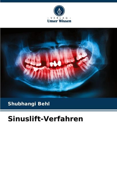 Sinuslift-Verfahren, Taschenbuch von Shubhangi Behl, Verlag Unser Wissen, 9786207800308