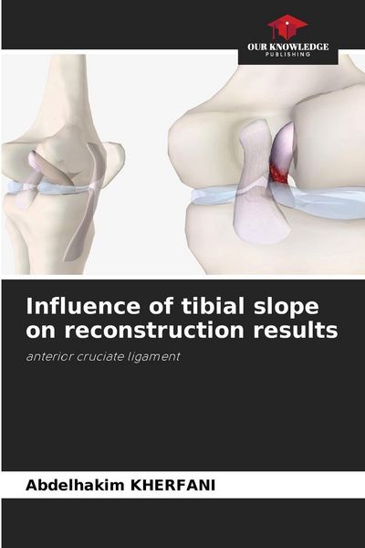 Produktbild: Influence of tibial slope on reconstruction results