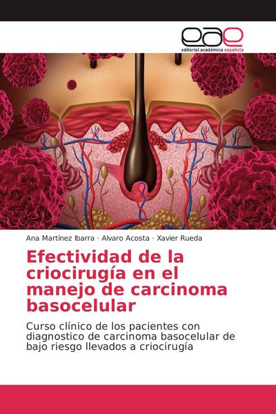 Produktbild: Efectividad de la criocirug&iacute;a en el manejo de carcinoma basocelular