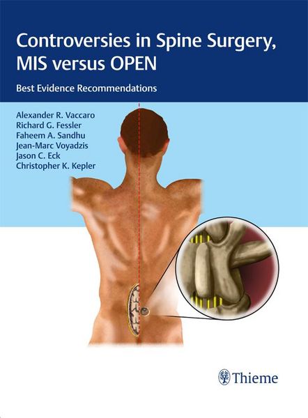Produktbild: Controversies in Spine Surgery, MIS versus OPEN