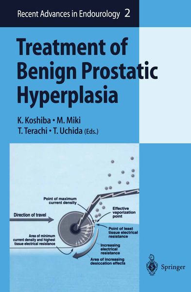 Produktbild: Treatment of Benign Prostatic Hyperplasia