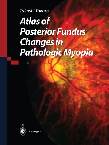 Produktbild: Atlas of Posterior Fundus Changes in Pathologic Myopia