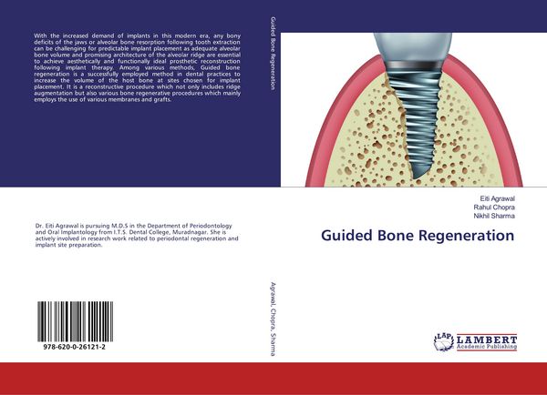 Produktbild: Guided Bone Regeneration