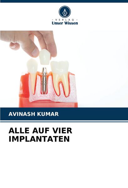 Alle Auf vier Implantaten, Taschenbuch von Avinash Kumar, Verlag Unser Wissen, 9786208300401