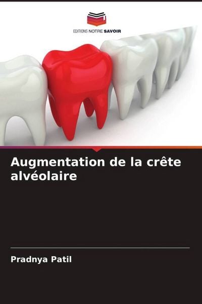 Produktbild: Augmentation de la cr&ecirc;te alv&eacute;olaire
