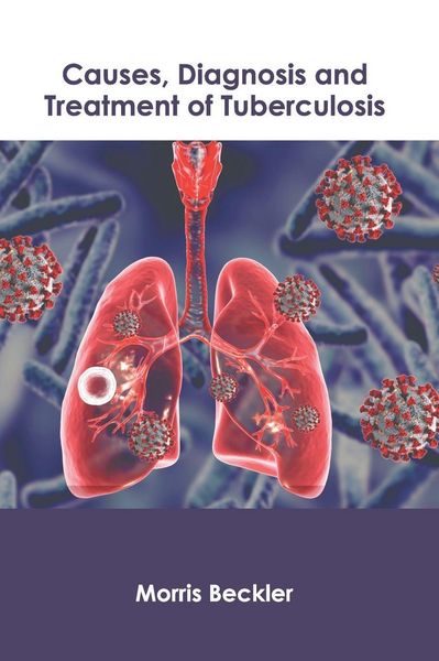 Produktbild: Causes, Diagnosis and Treatment of Tuberculosis