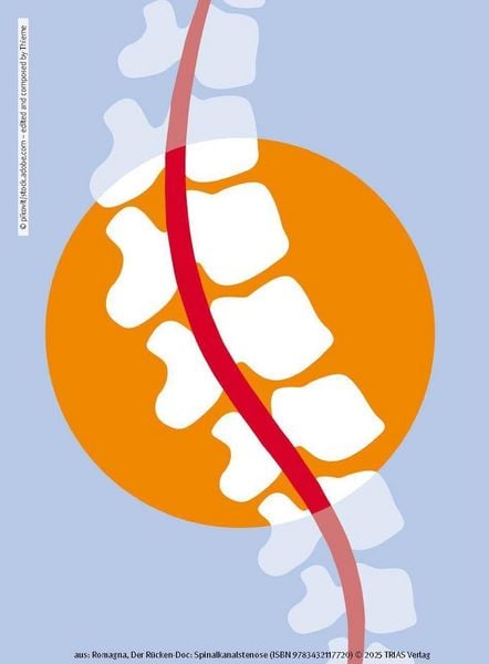 Produktbild: Der R&uuml;cken-Doc: Spinalkanalstenose