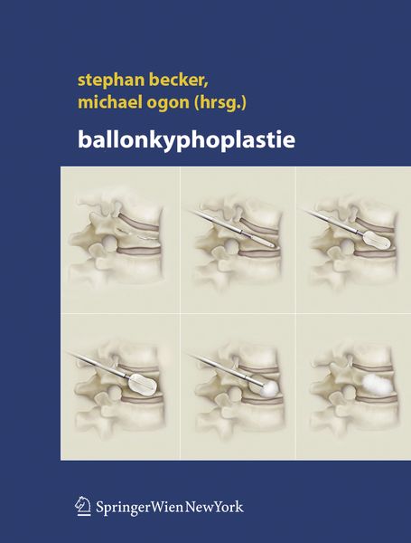 Produktbild: Ballonkyphoplastie