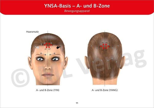 Schädelakupunktur nach Yamamoto (YNSA)