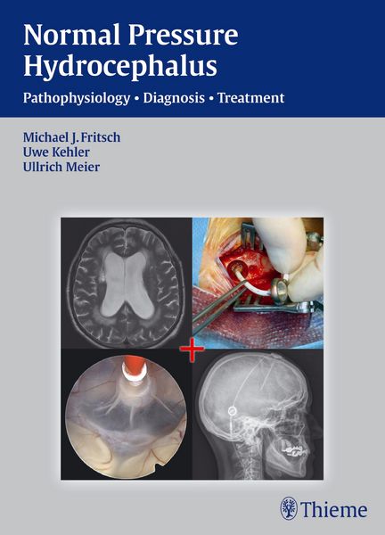 Produktbild: NPH - Normal Pressure Hydrocephalus