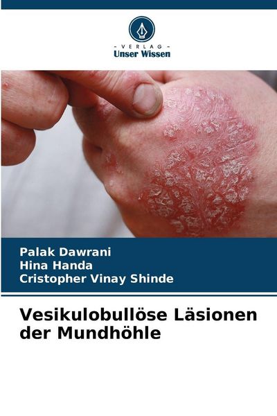 Produktbild: Vesikulobull&ouml;se L&auml;sionen der Mundh&ouml;hle