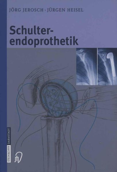 Produktbild: Schulterendoprothetik