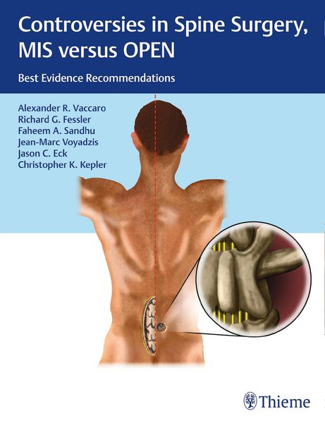 Produktbild: Controversies in Spine Surgery, MIS versus OPEN
