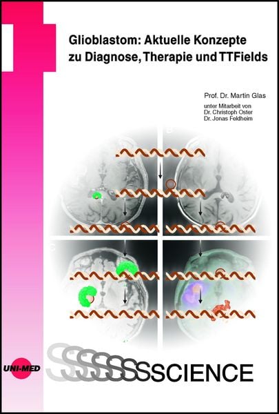 Produktbild: Glioblastom: Aktuelle Konzepte zu Diagnose, Therapie und TTFields