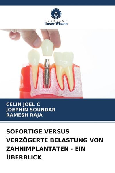 Sofortige Versus Verzögerte Belastung von Zahnimplantaten - ein Überblick, Taschenbuch von Celin Joel C. , Joephin Soundar , Ramesh RAJA, Verlag Unser