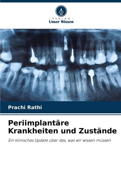 Periimplantäre Krankheiten und Zustände, Taschenbuch von Prachi Rathi, Verlag Unser Wissen, 9786207497621