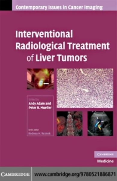 Produktbild: Interventional Radiological Treatment of Liver Tumors