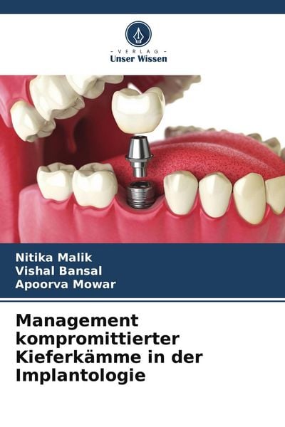 Management kompromittierter Kieferkämme in der Implantologie, Taschenbuch von Nitika Malik , Vishal Bansal , Apoorva Mowar, Verlag Unser Wissen,