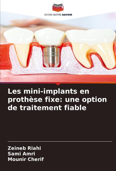 Produktbild: Les mini-implants en proth&egrave;se fixe: une option de traitement fiable
