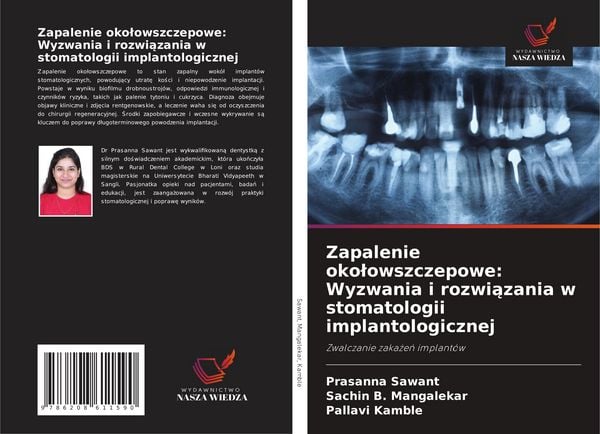 Produktbild: Zapalenie oko&iquest;owszczepowe: Wyzwania i rozwi&iquest;zania w stomatologii implantologicznej