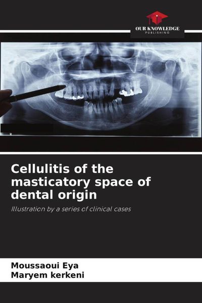 Produktbild: Cellulitis of the masticatory space of dental origin
