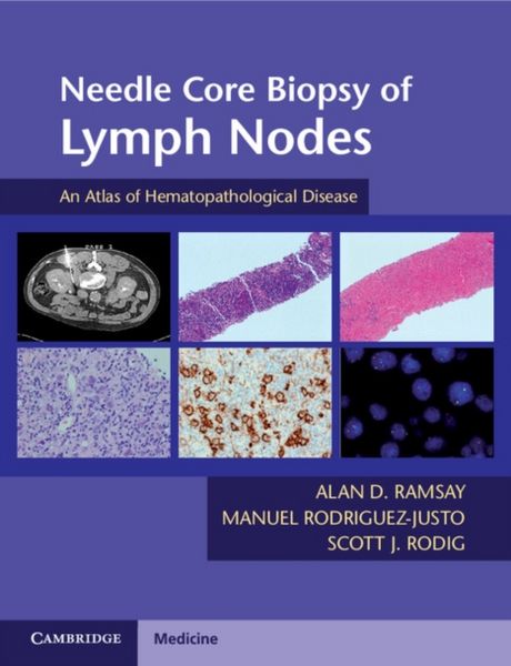 Produktbild: Needle Core Biopsy Of Lymph No