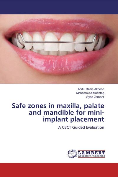 Produktbild: Safe zones in maxilla, palate and mandible for mini-implant placement