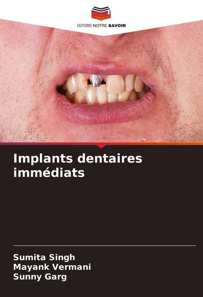 Produktbild: Implants dentaires imm&eacute;diats