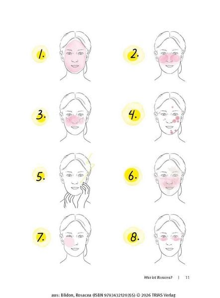 Produktbild: Rosacea