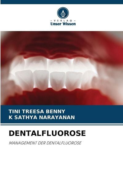 Dentalfluorose, Taschenbuch von Tini Treesa Benny , K. Sathya Narayanan, Verlag Unser Wissen, 9786200711861