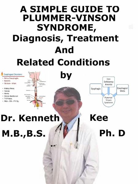 Produktbild: A Simple Guide to Plummer-Vinson Syndrome, Diagnosis, Treatment and Related Conditions