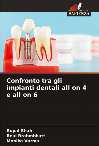 Produktbild: Confronto tra gli impianti dentali all on 4 e all on 6