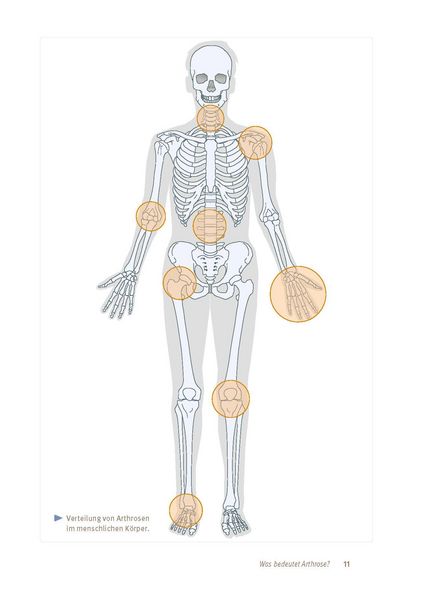 Produktbild: Arthrose