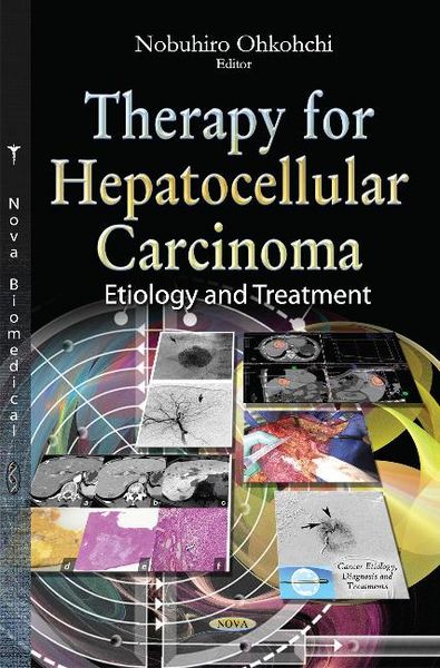 Produktbild: Therapy for Hepatocellular Carcinoma