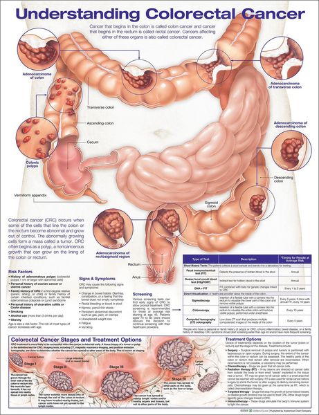 Produktbild: Understanding Colorectal Cancer Anatomical Chart