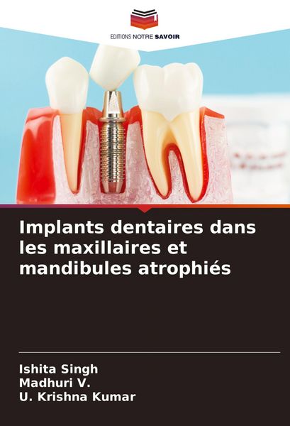 Produktbild: Implants dentaires dans les maxillaires et mandibules atrophi&eacute;s
