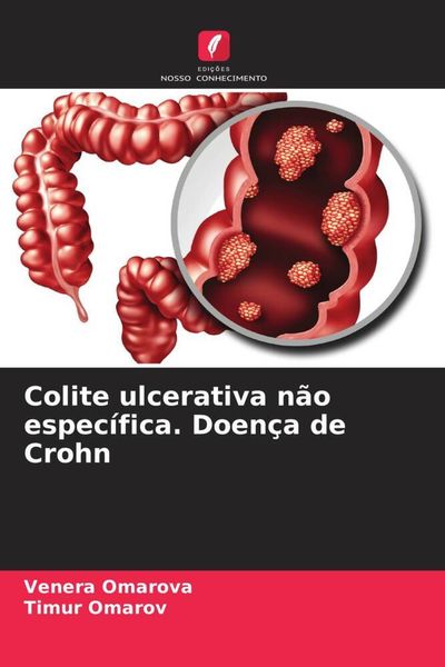 Produktbild: Colite ulcerativa n&atilde;o espec&iacute;fica. Doen&ccedil;a de Crohn