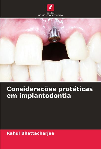 Produktbild: Considera&ccedil;&otilde;es prot&eacute;ticas em implantodontia