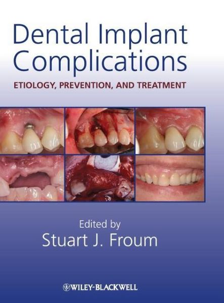 Produktbild: Dental Implant Complications
