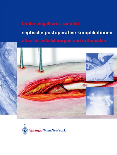 Produktbild: Septische postoperative Komplikationen