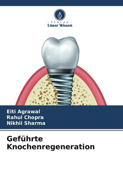 Geführte Knochenregeneration, Taschenbuch von Eiti Agrawal , Rahul Chopra , Nikhil Sharma, Verlag Unser Wissen, 9786204820842