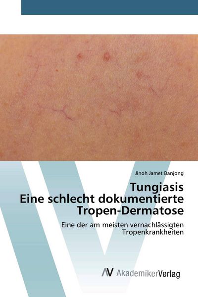 TungiasisEine schlecht dokumentierte Tropen-Dermatose, Taschenbuch von Jinoh Jamet Banjong, AV Akademikerverlag, 9786200657374