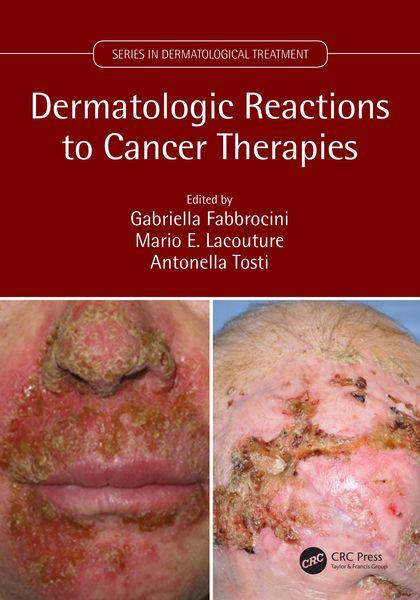 Produktbild: Dermatologic Reactions to Cancer Therapies