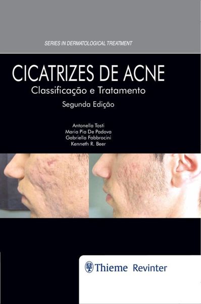 Produktbild: Cicatrizes de Acne